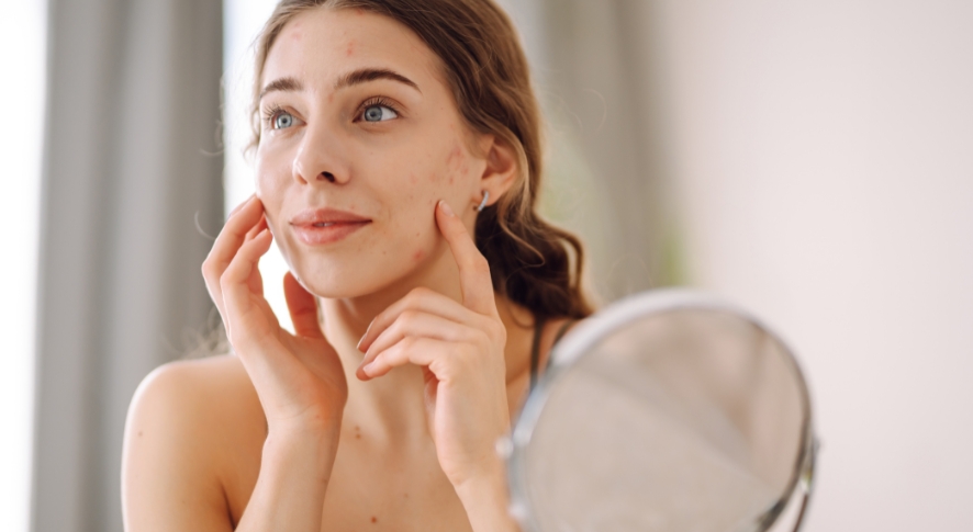 Morpheus8 for Scars: Acne, Surgical & Stretch Marks